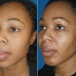 Buccal Fat Pad Reduction Richmond VA