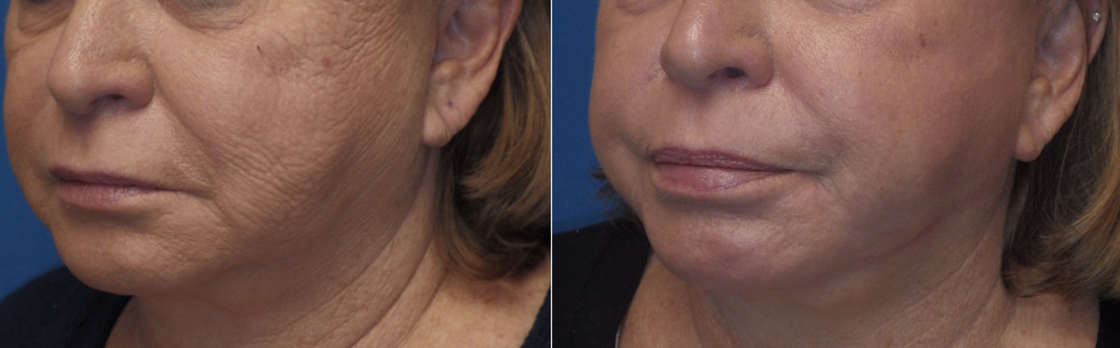 CO2 Laser Resurfacing Richmond VA Laser Skin Treatment Wrinkles