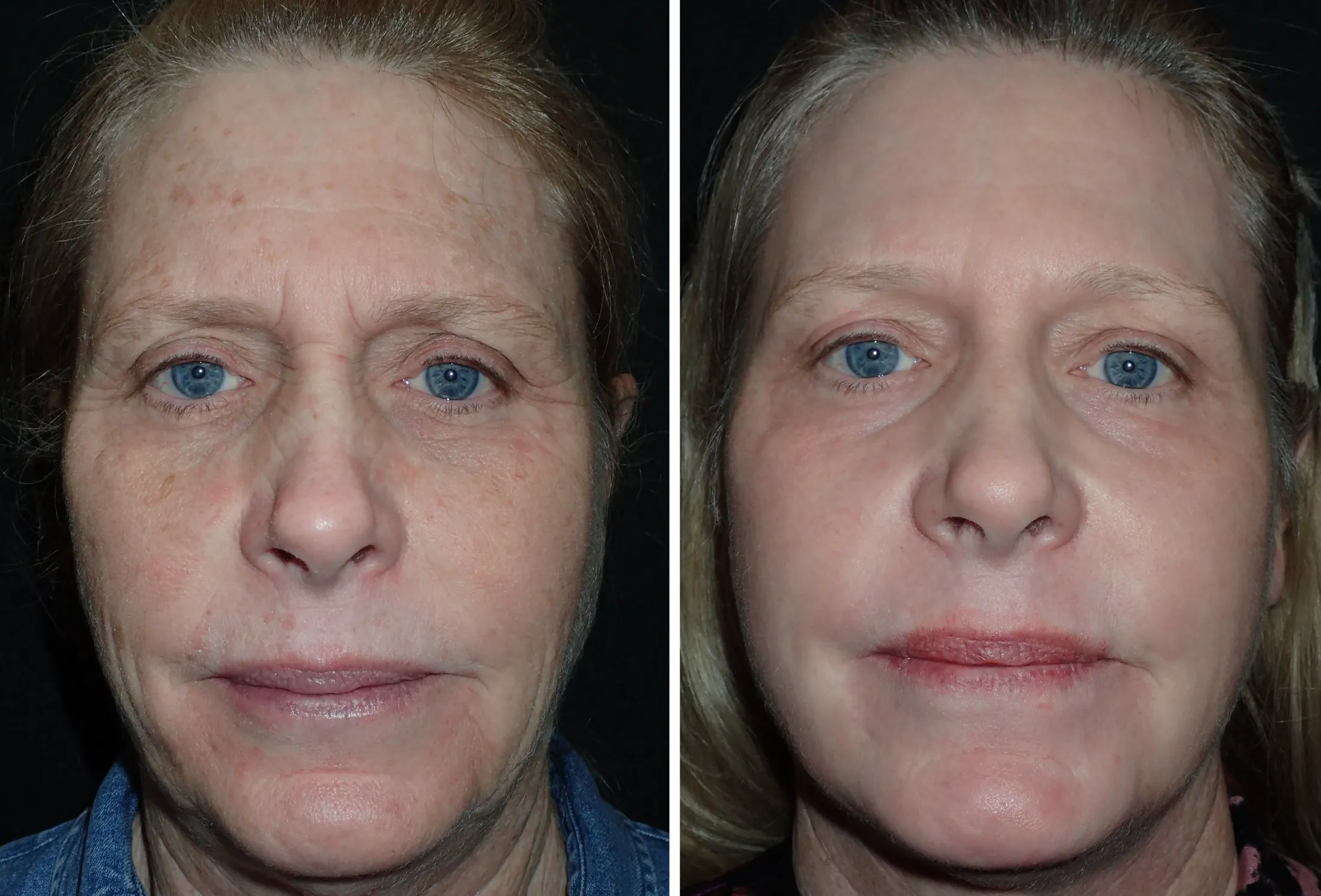 CO2 Laser Resurfacing Richmond VA Laser Skin Treatment Wrinkles