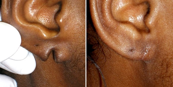 Earlobe Repair Otoplasty Virginia