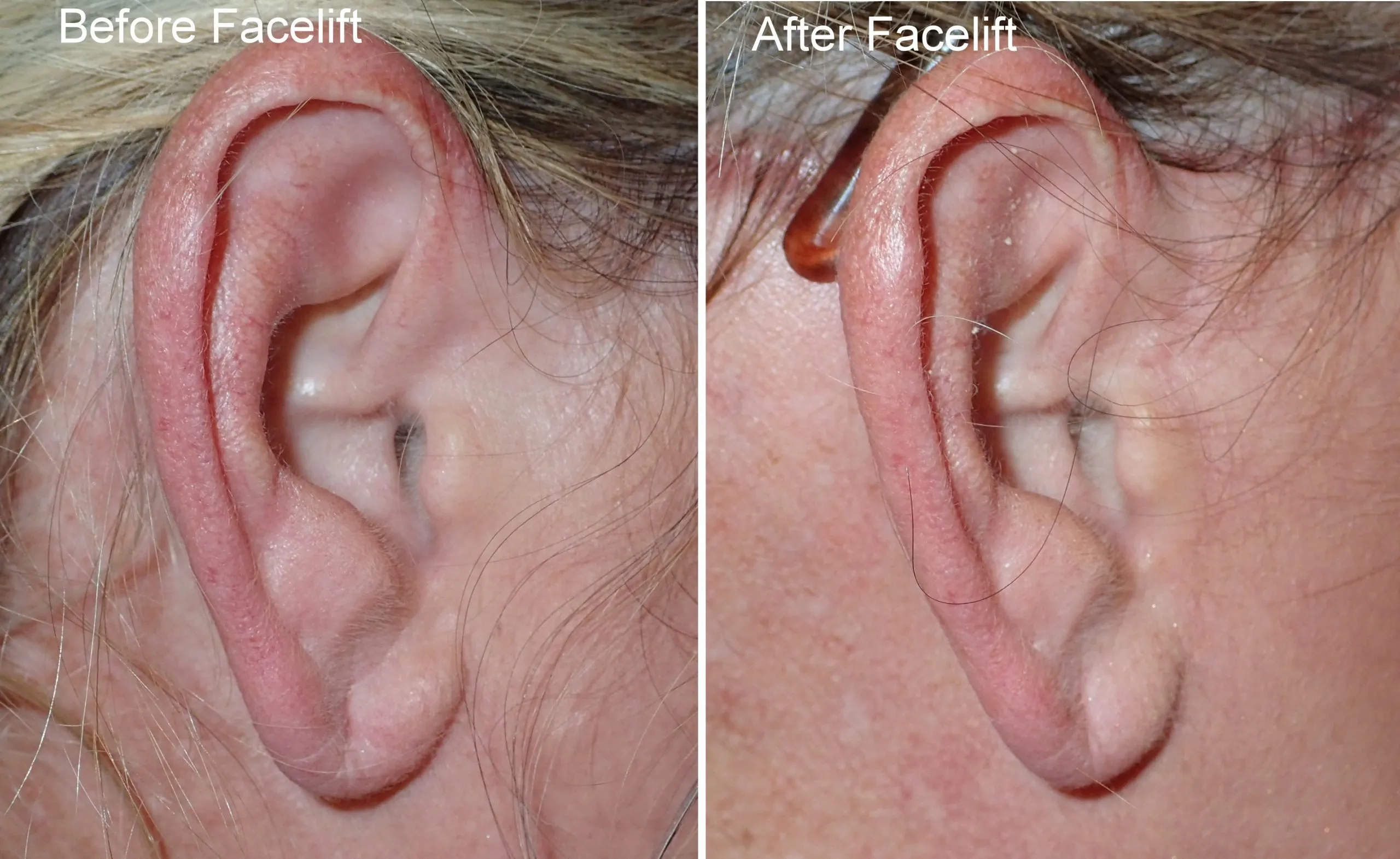 Types of Facelift Incisions: What To Expect & Which Is Best For You? - EIPS